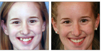 kimberly before and after orthodontics work
