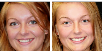 rebecca before and after tooth replacement