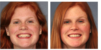 sarah before and after orthodontics work