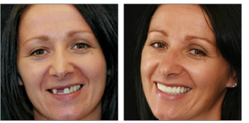 siobhan before and after dental reconstruction