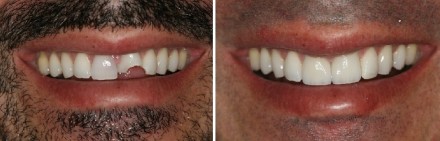before and after photo of a smile with a chipped tooth