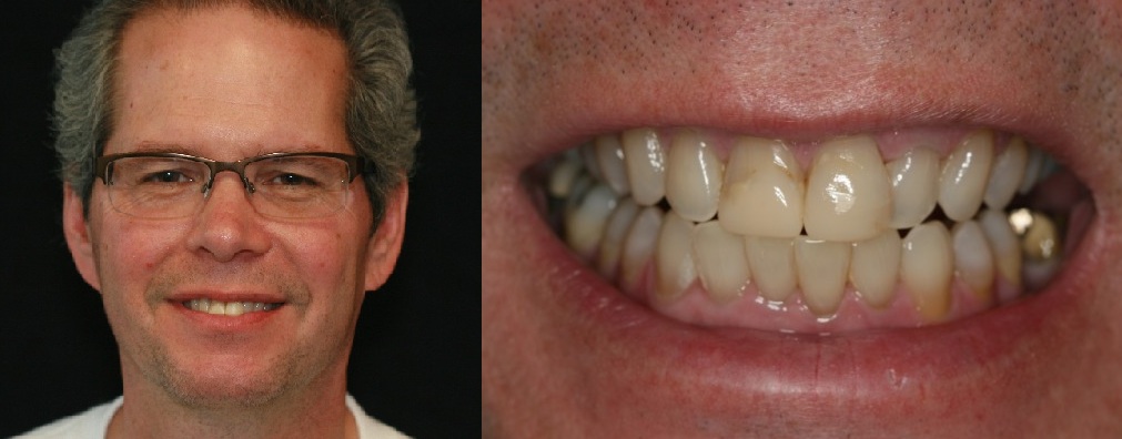 Peter with Cosmetic Bonding for Chipped Teeth