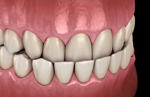 Illustration of an underbite