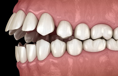 Illustration of an open bite