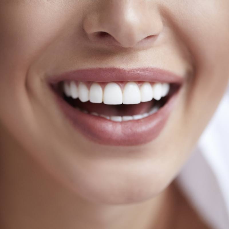 Close up of smile after cosmetic bonding