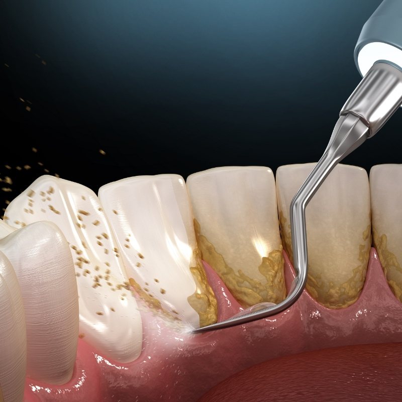 Teeth being cleaned for root canal treatment in Boston