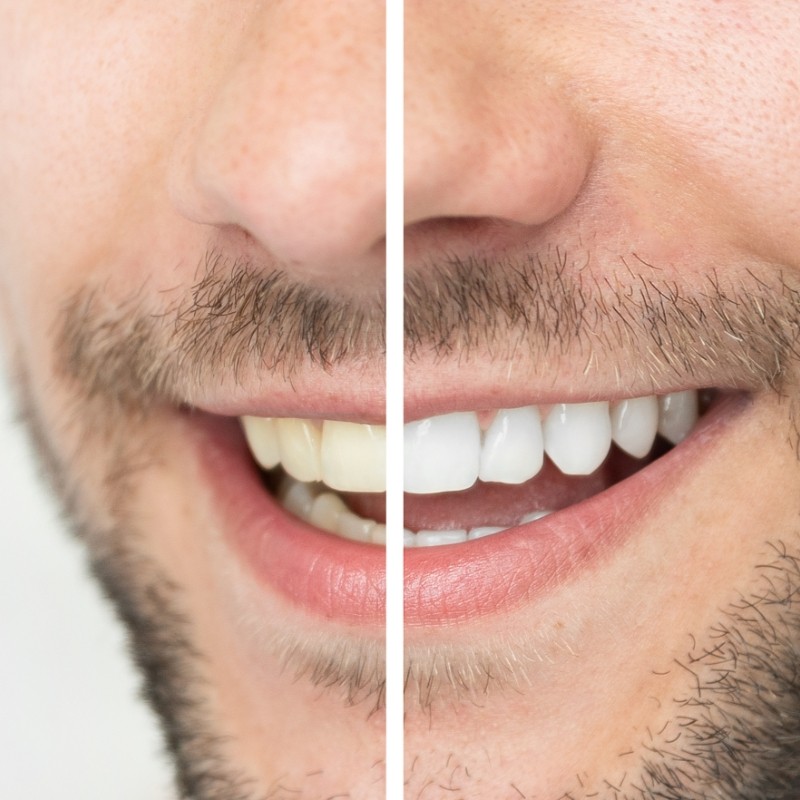 Close up of teeth before and after whitening