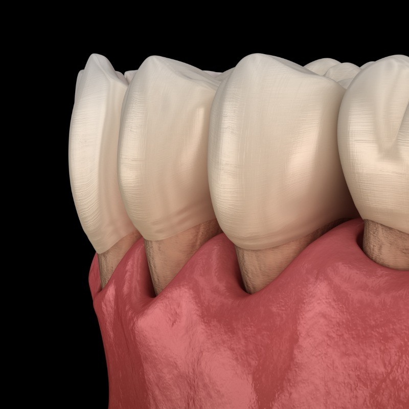 Illustration of gums receding