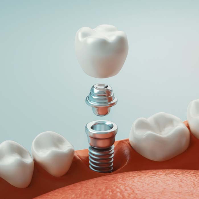 Illustration of dental implant and crown and abutments being inserted into jaw