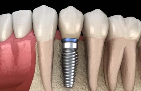 Illustration of a single dental implant in jaw