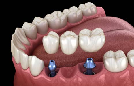 Illustration of bridge being attached to dental implants