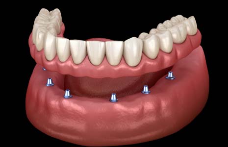 Illustration of dentures being attached to dental implants