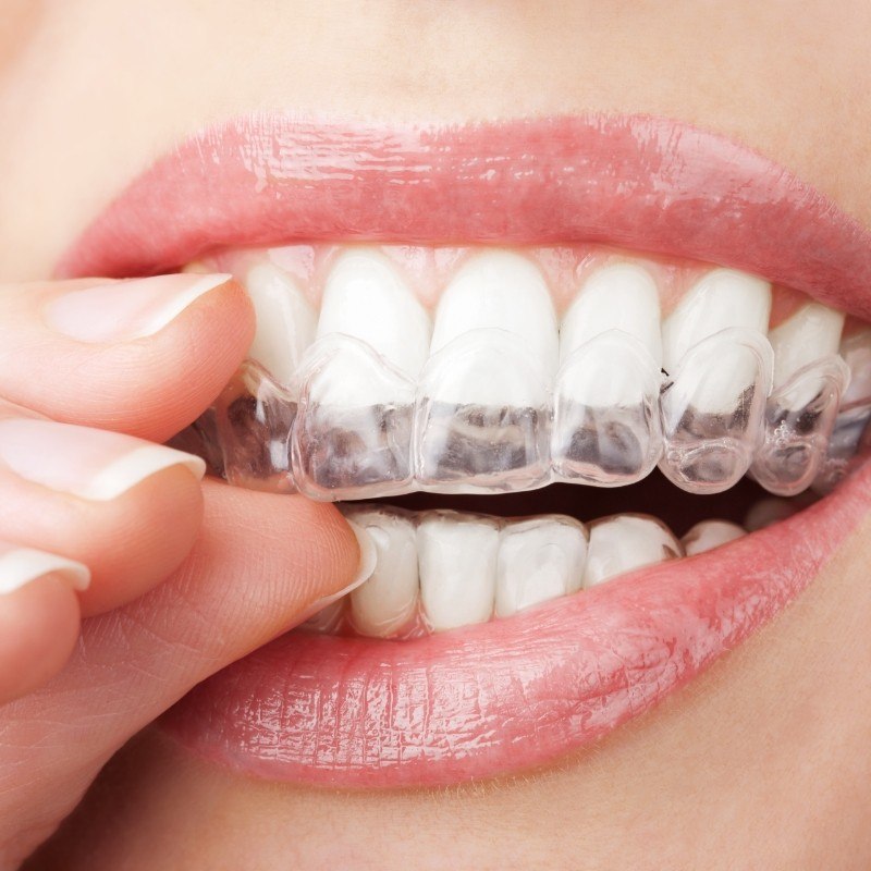 Putting in a clear aligner