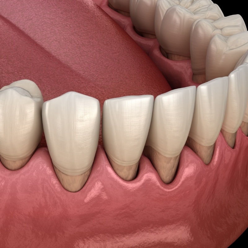 Illustration of receding gums needing gum disease treatment in Boston