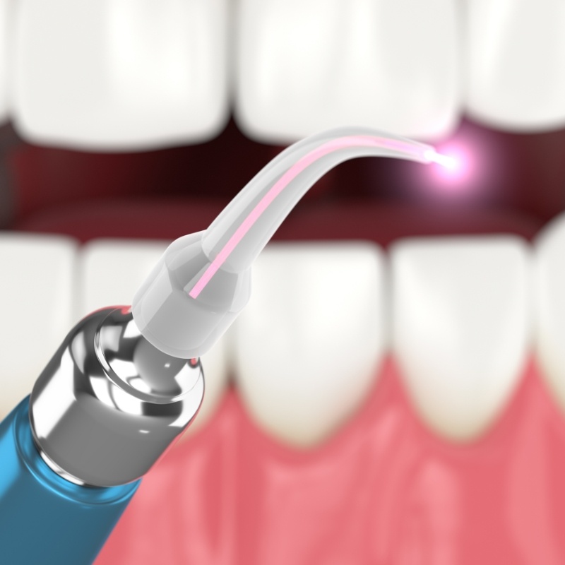 Close up of dental laser in front of teeth