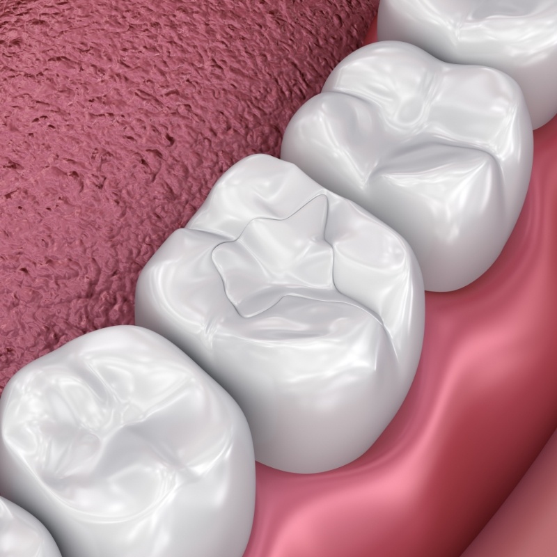 Illustration of teeth with tooth colored fillings in Boston