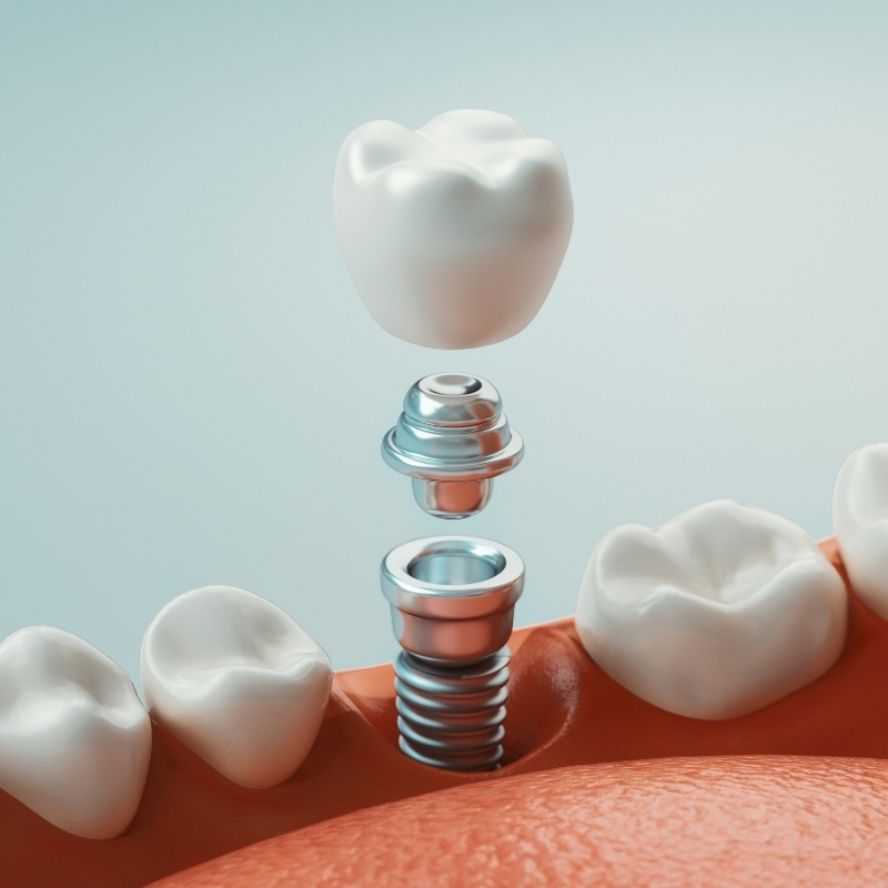 Illustration of dental implant crown and abutment