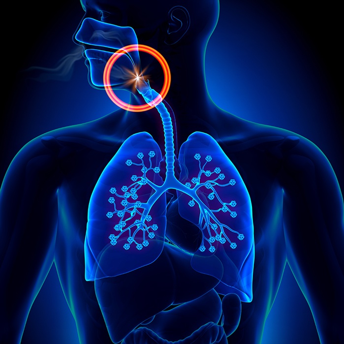 Illustration of airway being obstructed during sleep apnea