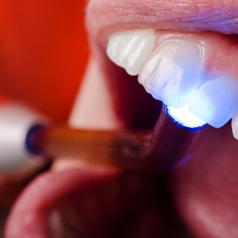 Composite resin fillings being hardened in place