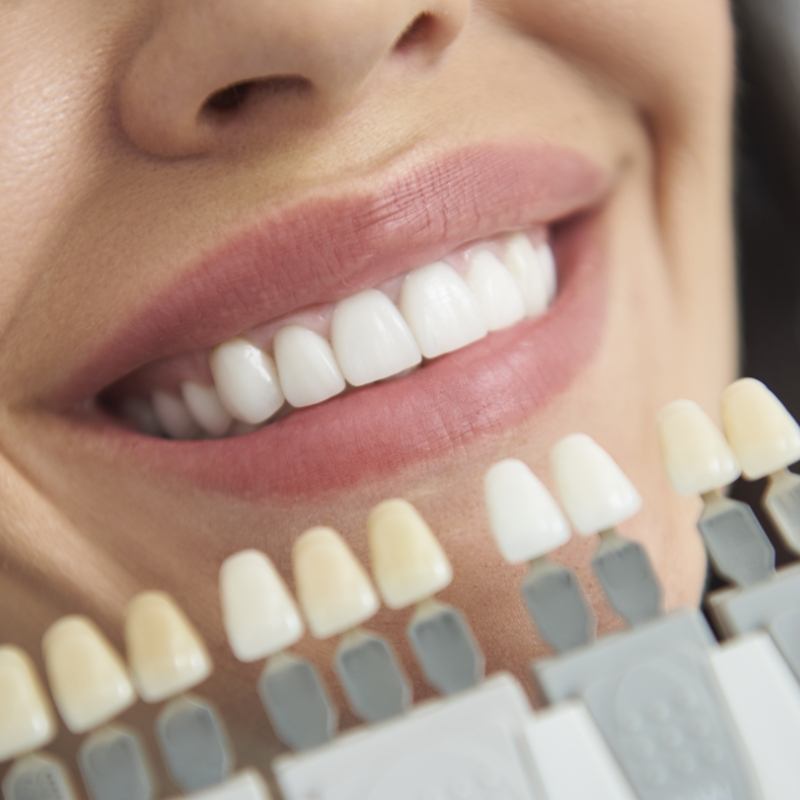 Woman being color matched for veneers in Boston