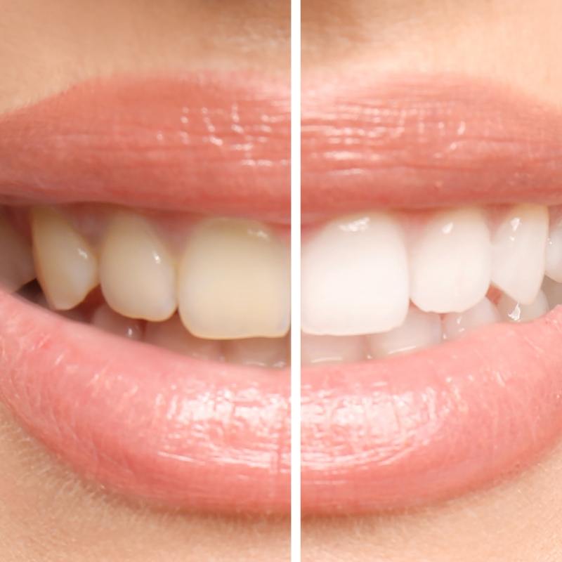 Close up of teeth before and after whitening