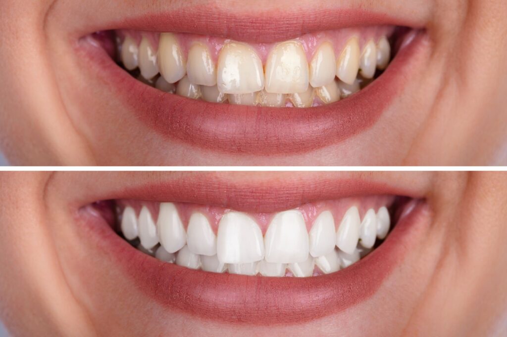 A before and after photo of professional teeth whitening