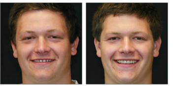 shane before and after photos with veneers