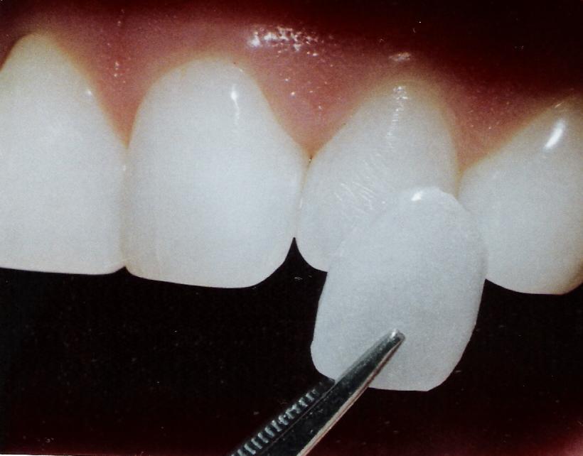 veneer getting placed over tooth